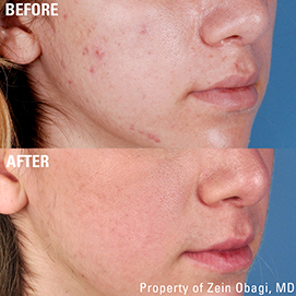 ACNE before after5 1