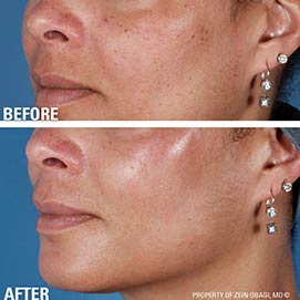 AGEING before after2