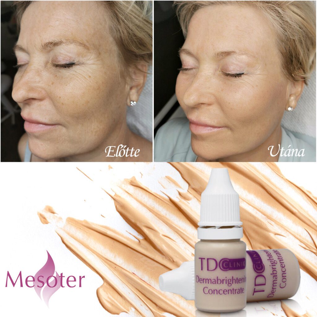 mesoter mezoterápia