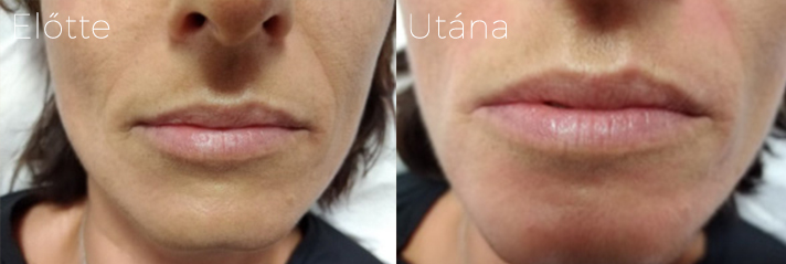 phorma laser elotte utana kep ajak koruli rancok