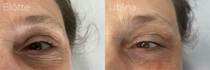 phorma laser elotte utana kep szem koruli rancok