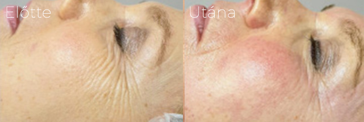 phorma laser elotte utana kep szem koruli rancok2