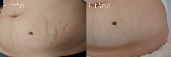 phorma laser elotte utana stria