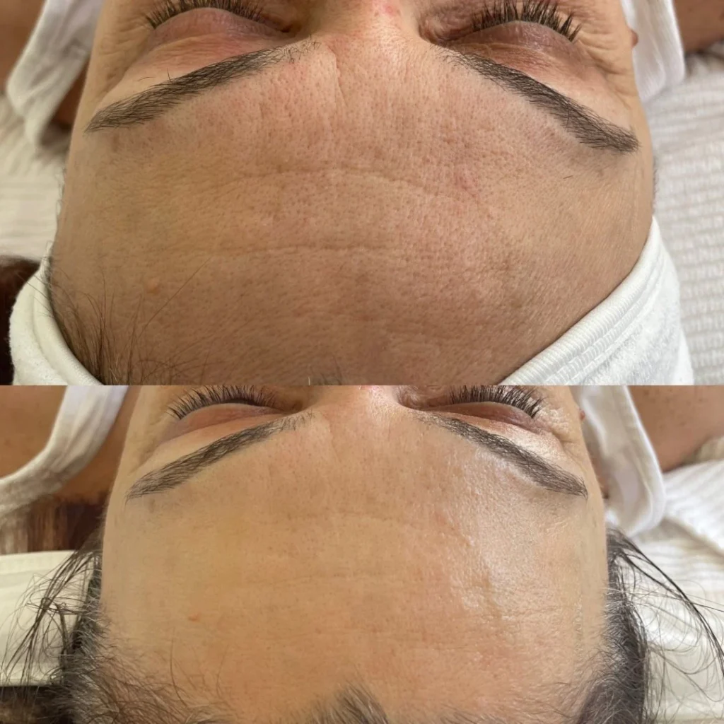 Carboxy terapia elotte utana 1