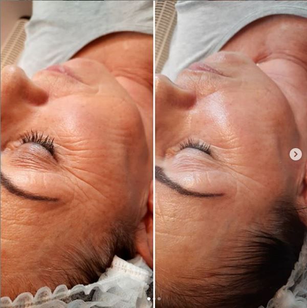 Carboxy terapia elotte utana 1