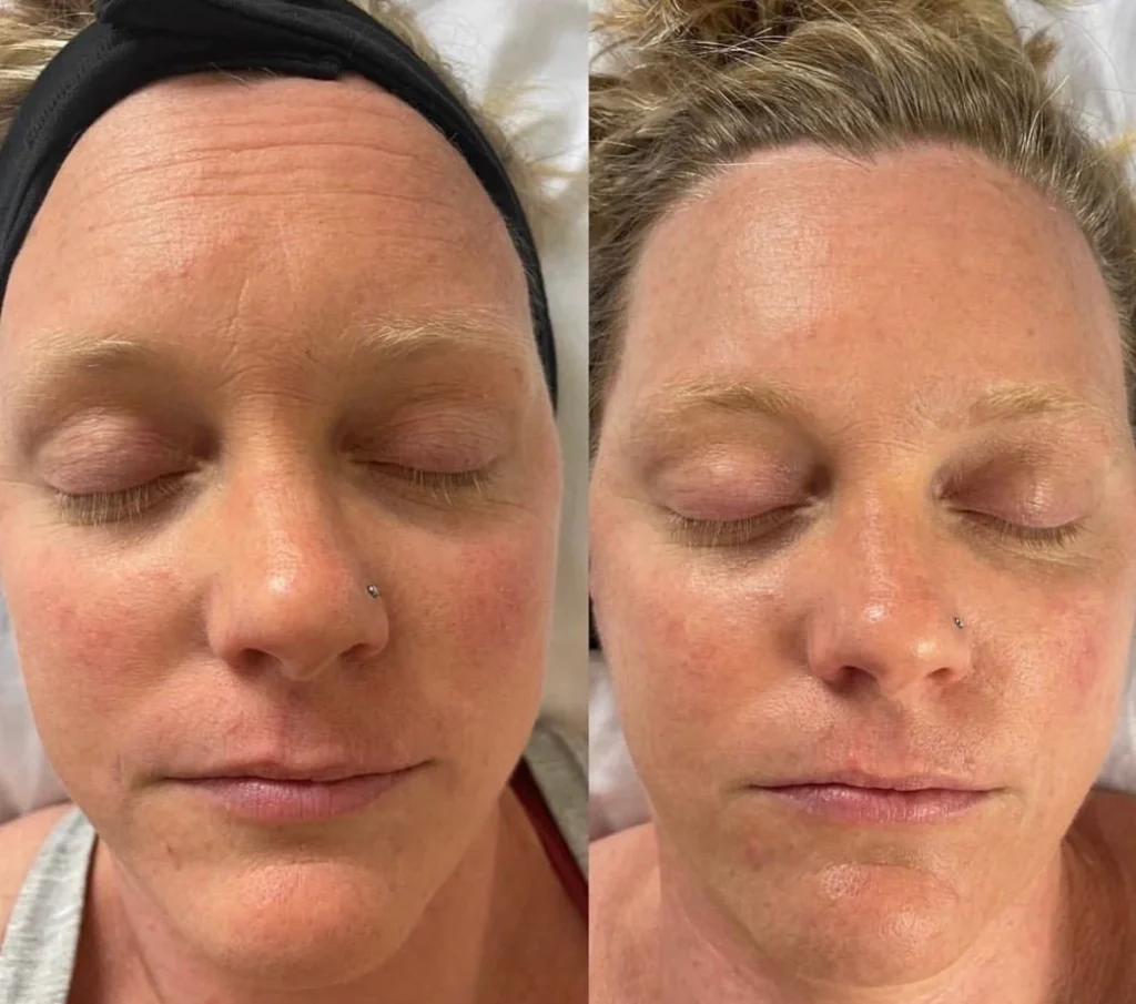 Carboxy terapia elotte utana 2