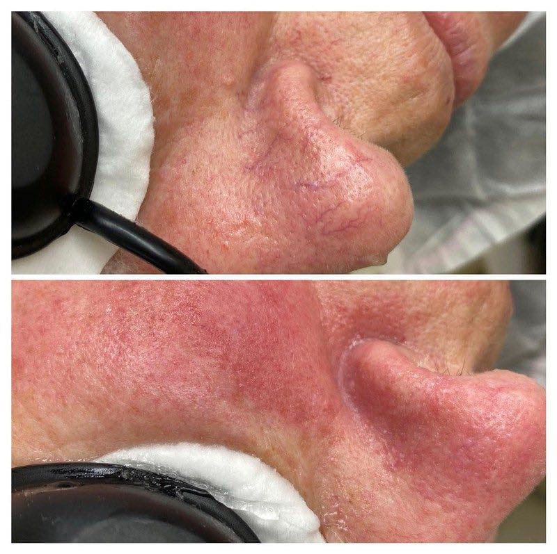 Veinstar elotteutana 1