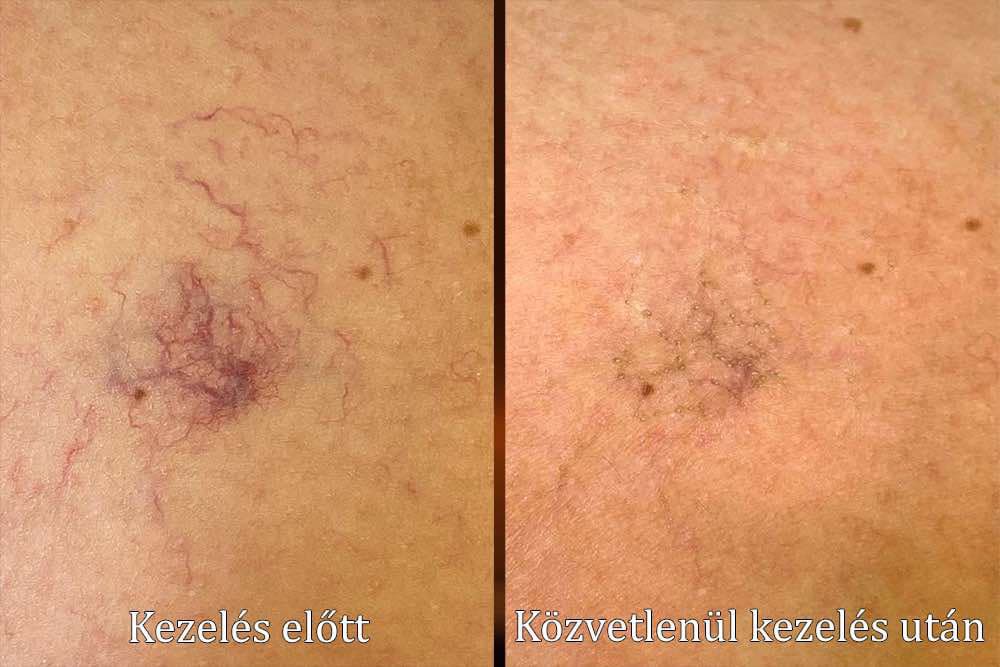 Veinstar elotteutana 2