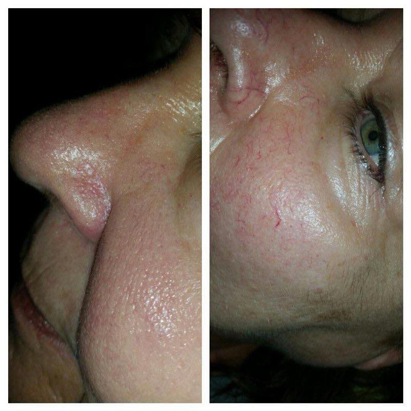 Veinstar elotteutana 3