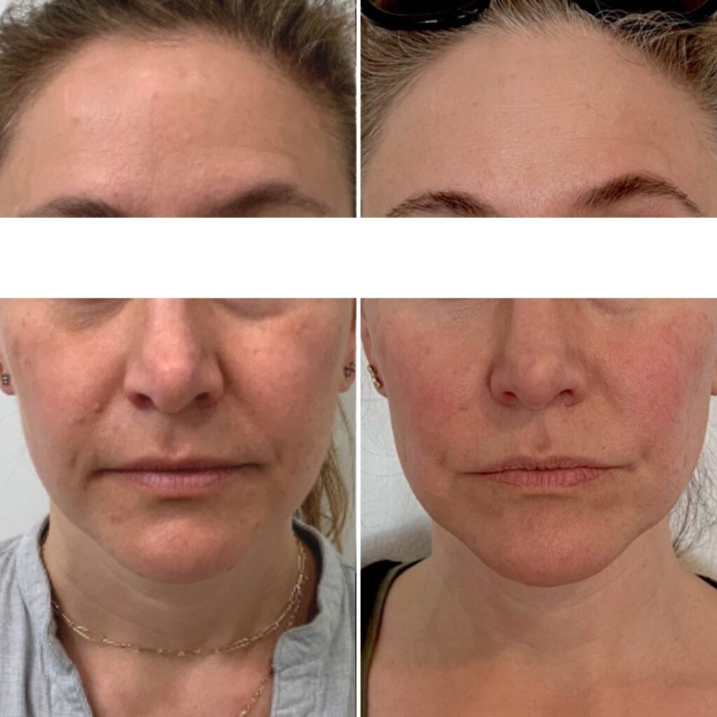 exosome terapia elotte utana (1)