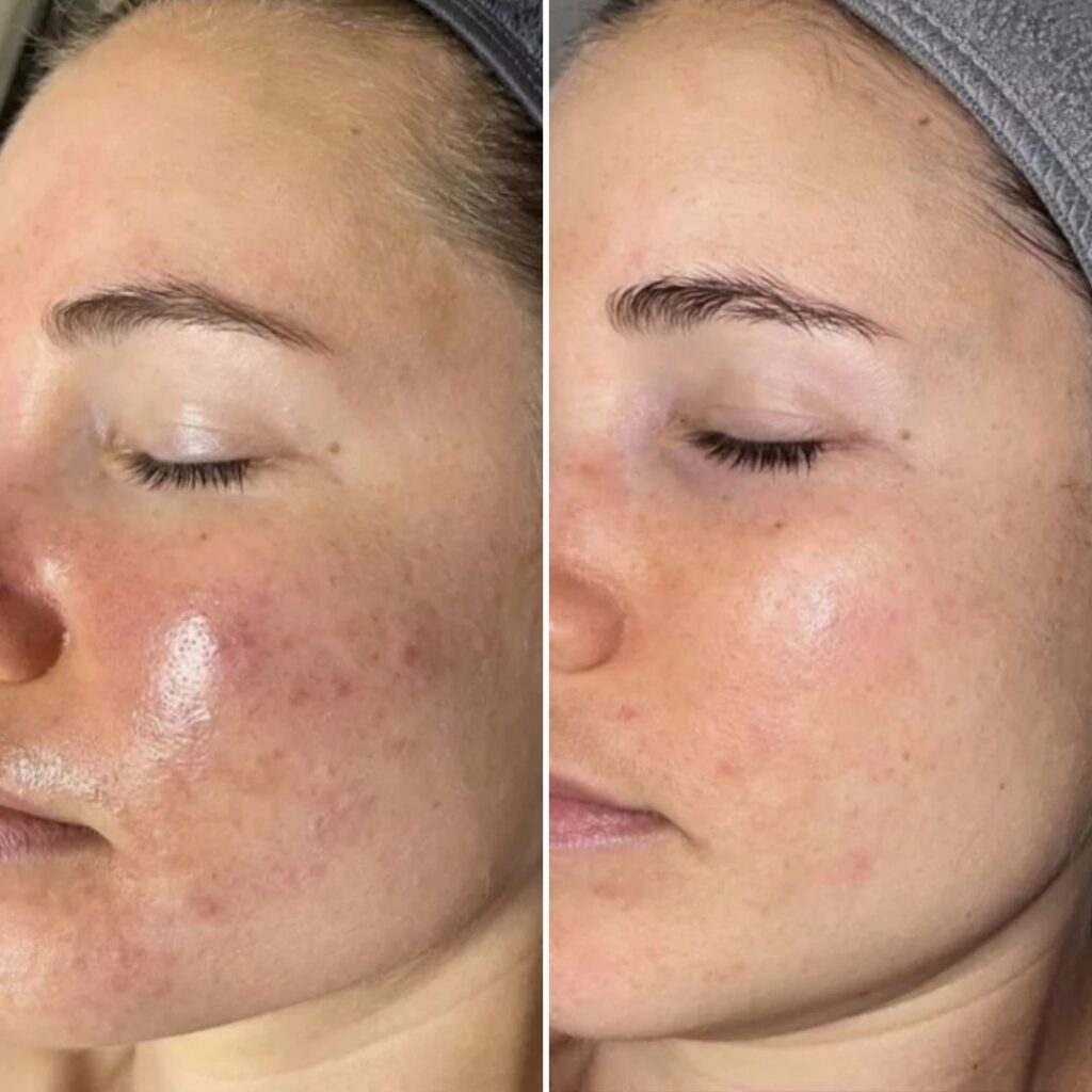 exoszoma terapia eredmenyek