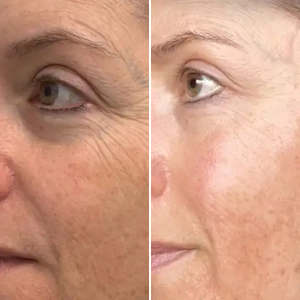 exoszoma terapia elotte utana