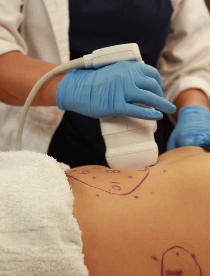 liposonic hifu feszesites szolnok mosonyi beauty