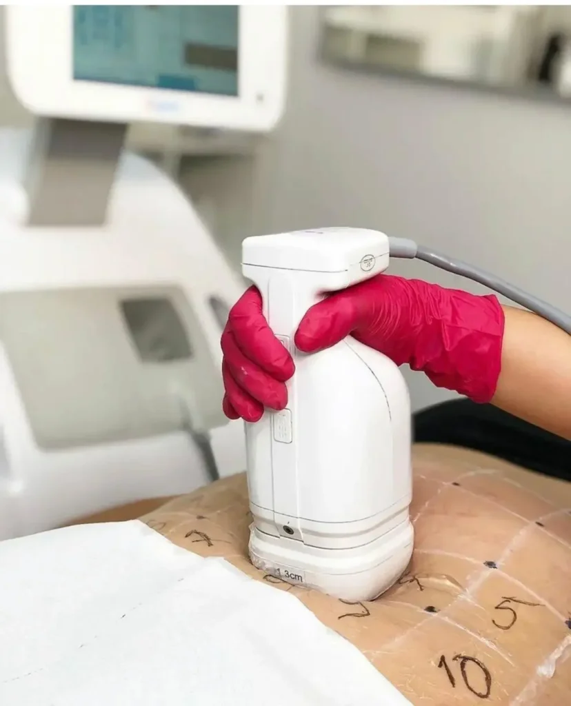 liposonic hifu zsirbontas szolnok mosonyi beauty
