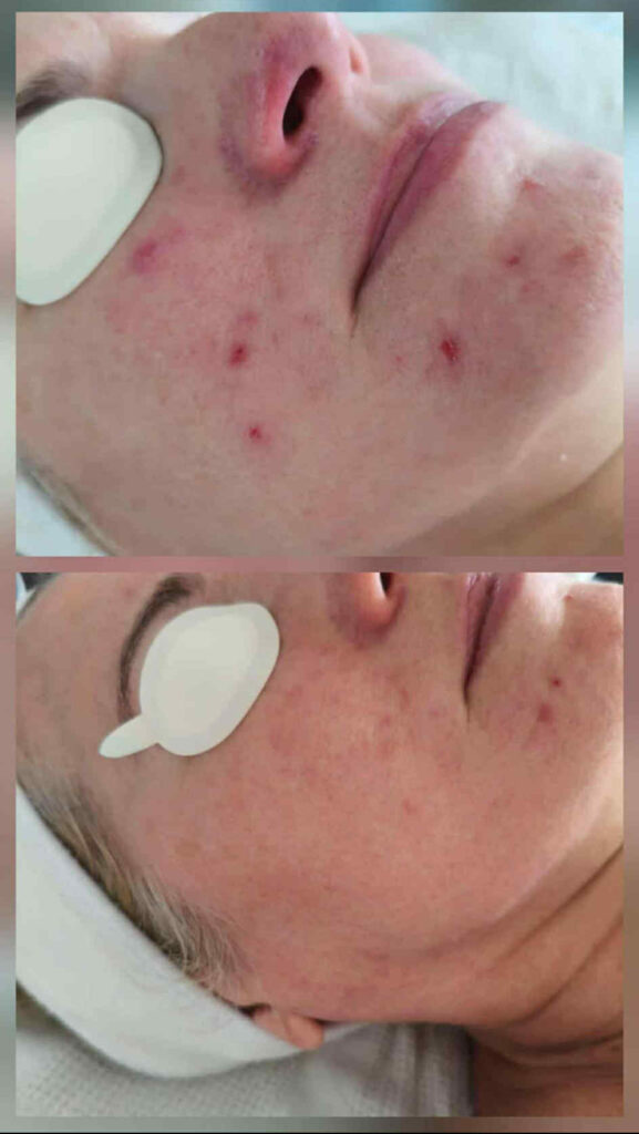 hidegplazma mosonyi beauty