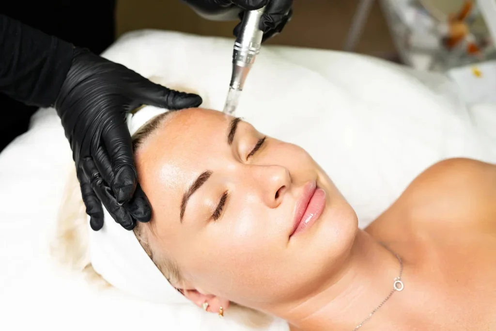 salmon dna microneedling a revolutionary skincare treatment